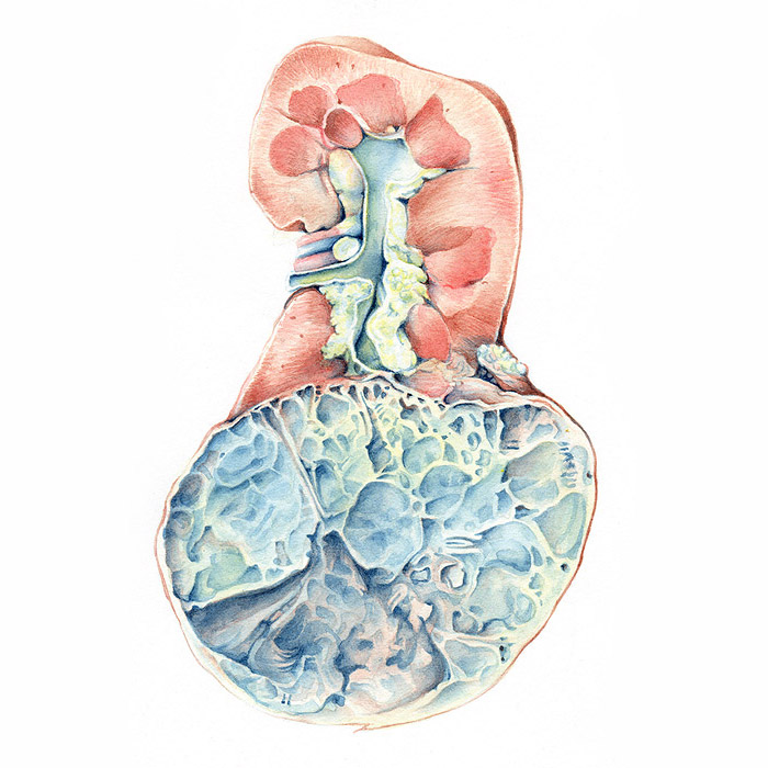 Illustration of a diseased kidney